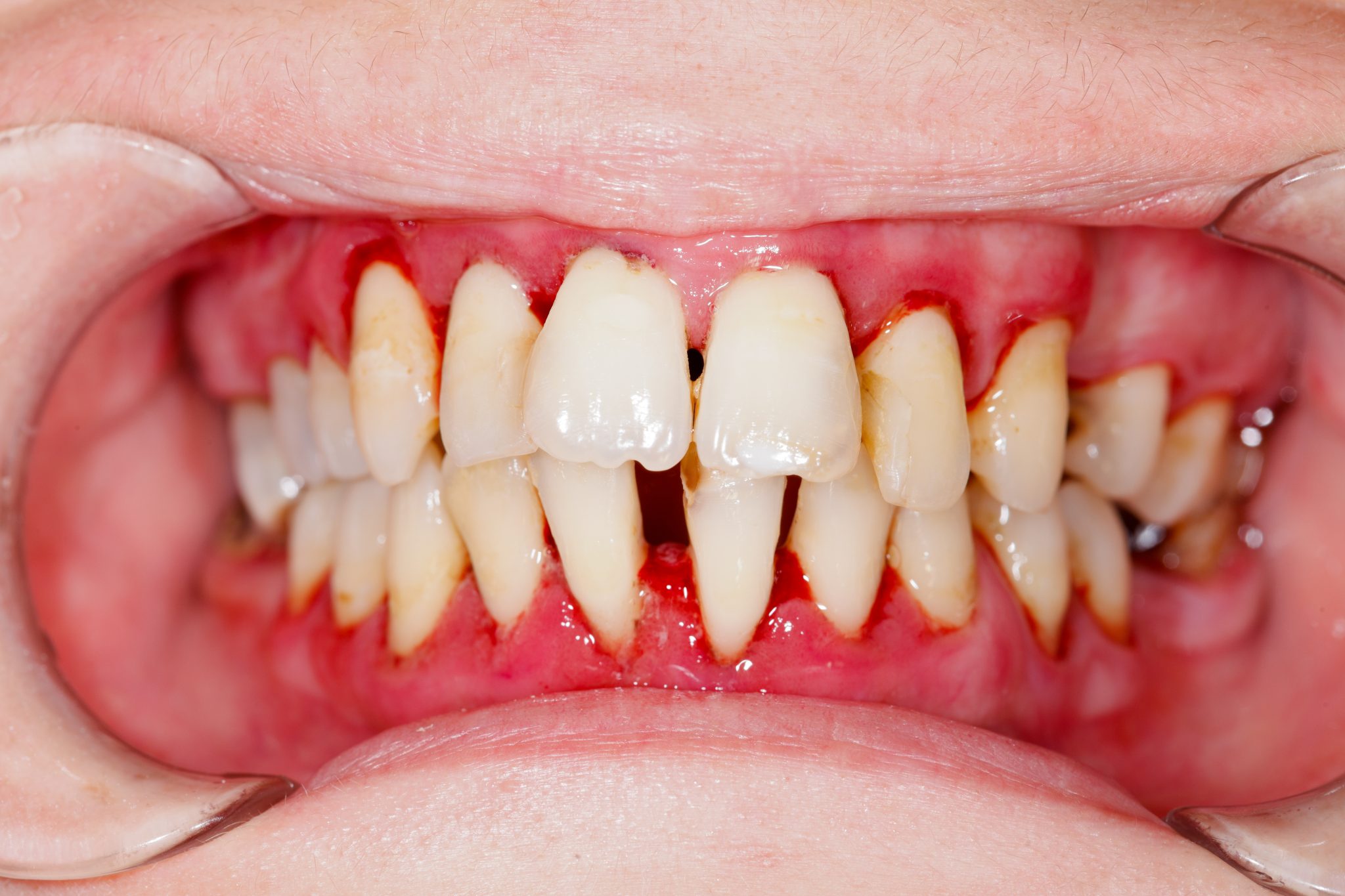 4 Telltale Signs Of Gum Disease In Solihull Coventry Balsall 