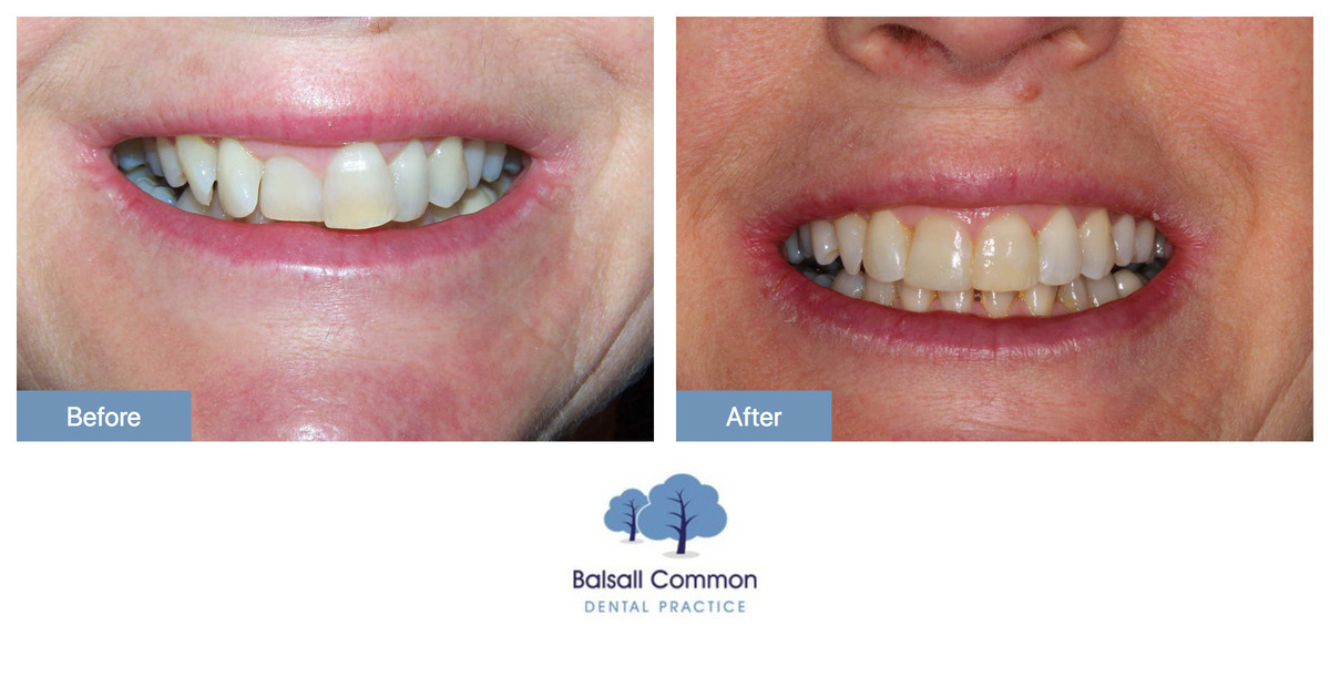 Clear aligners and bonding - Balsall Common Dental