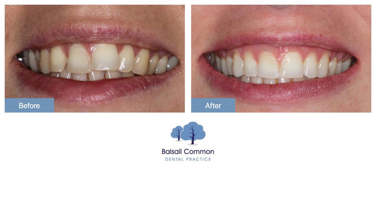 Removable clear aligner treatment and whitening - Balsall Common Dental