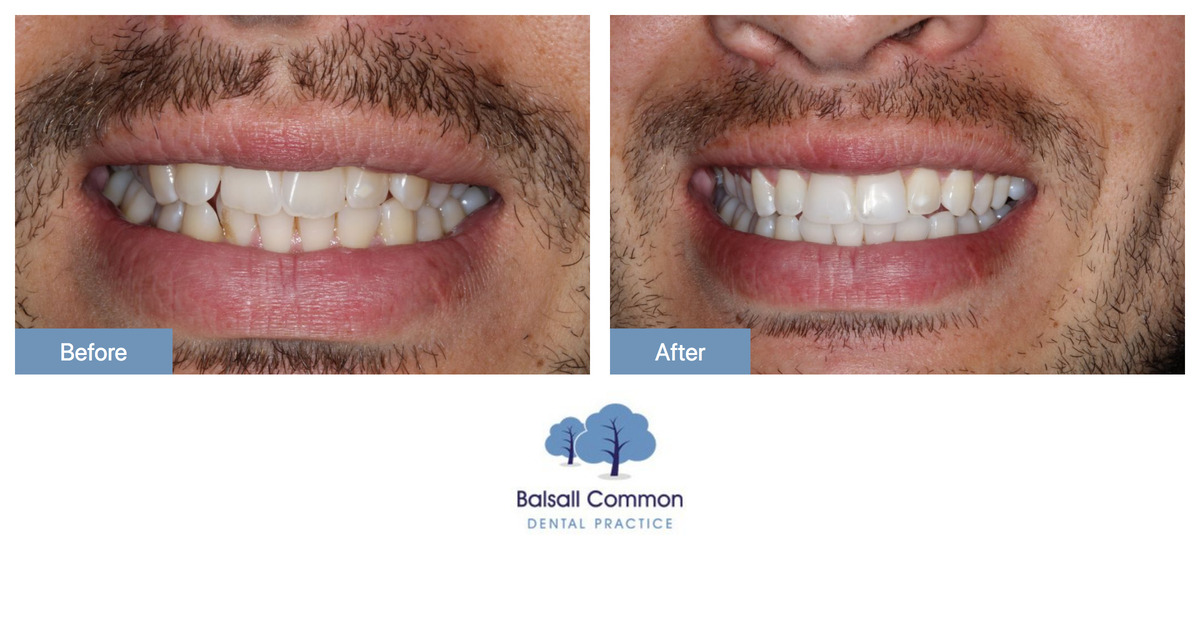 Teeth Straightening And Whitening Treatment Balsall Common Dental 0657