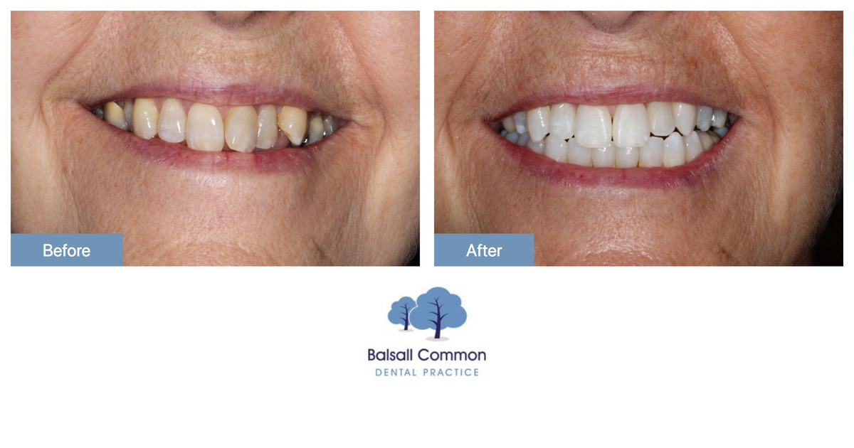 Teeth Whitening and Straightening - Balsall Common Dental